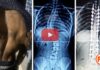 ¿Dudas del poder de Dios? Hombre con escoliosis recibe sanidad instantáneamente