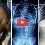 ¿Dudas del poder de Dios? Hombre con escoliosis recibe sanidad instantáneamente